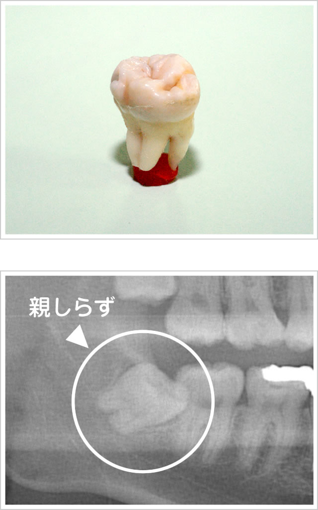 親しらずイメージ写真