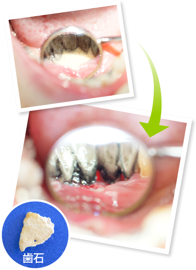 歯のクリーニング　Befor After