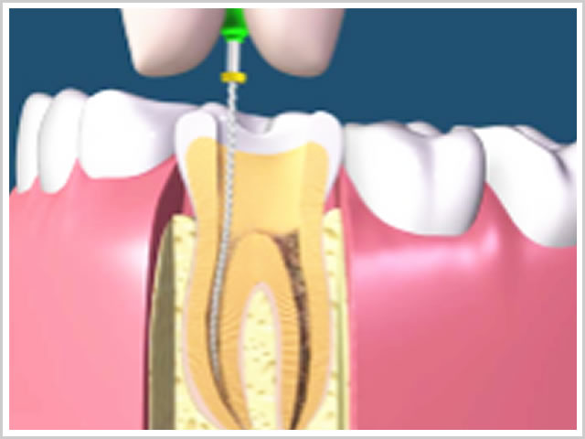歯の根っこの治療レントゲン写真