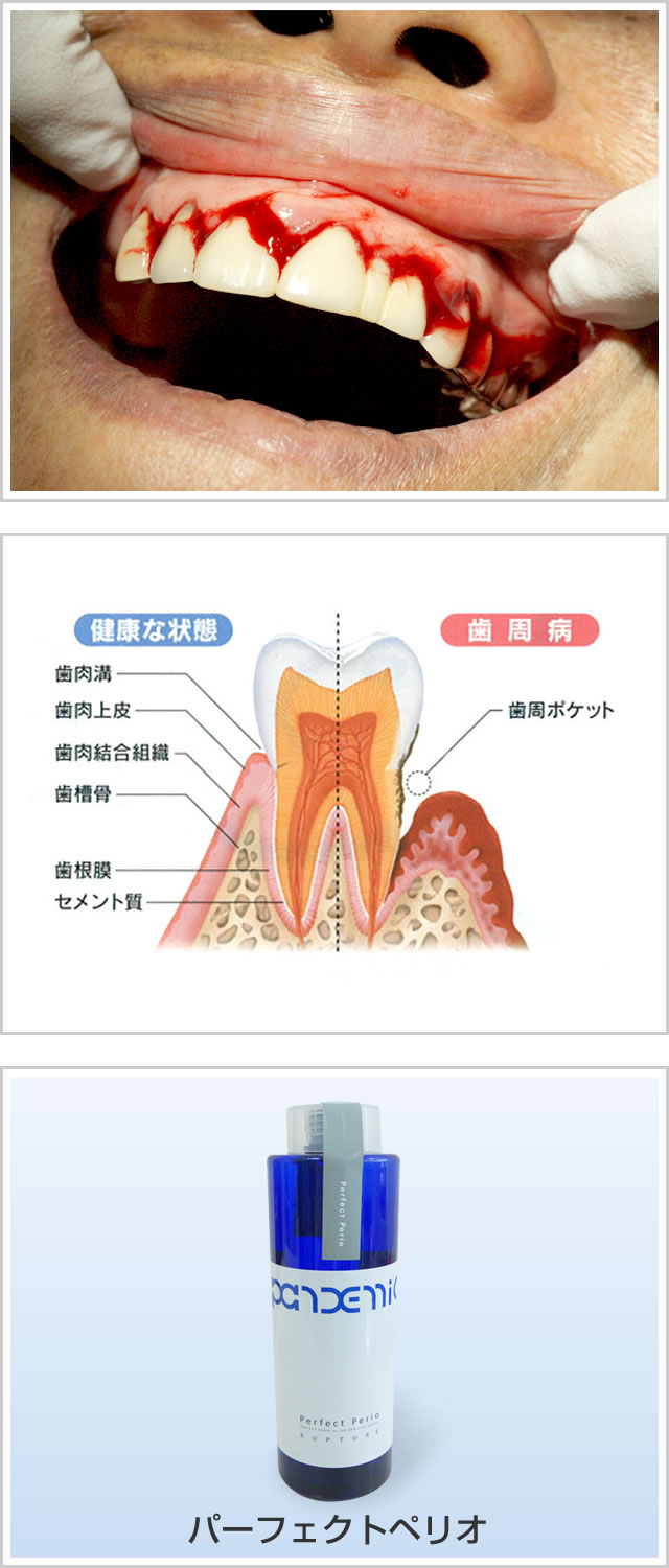 歯周病写真