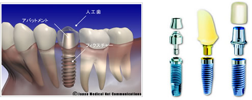 インプラントイメージ画像