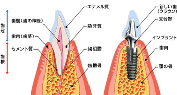 インプラントイメージ画像