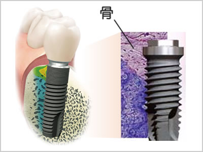 インプラントイメージ画像