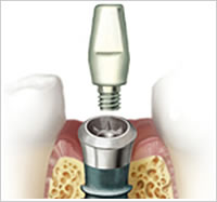 アバットメント（支台）の装着イメージ画像