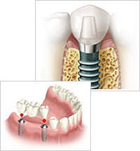 人工歯の装着イメージ画像